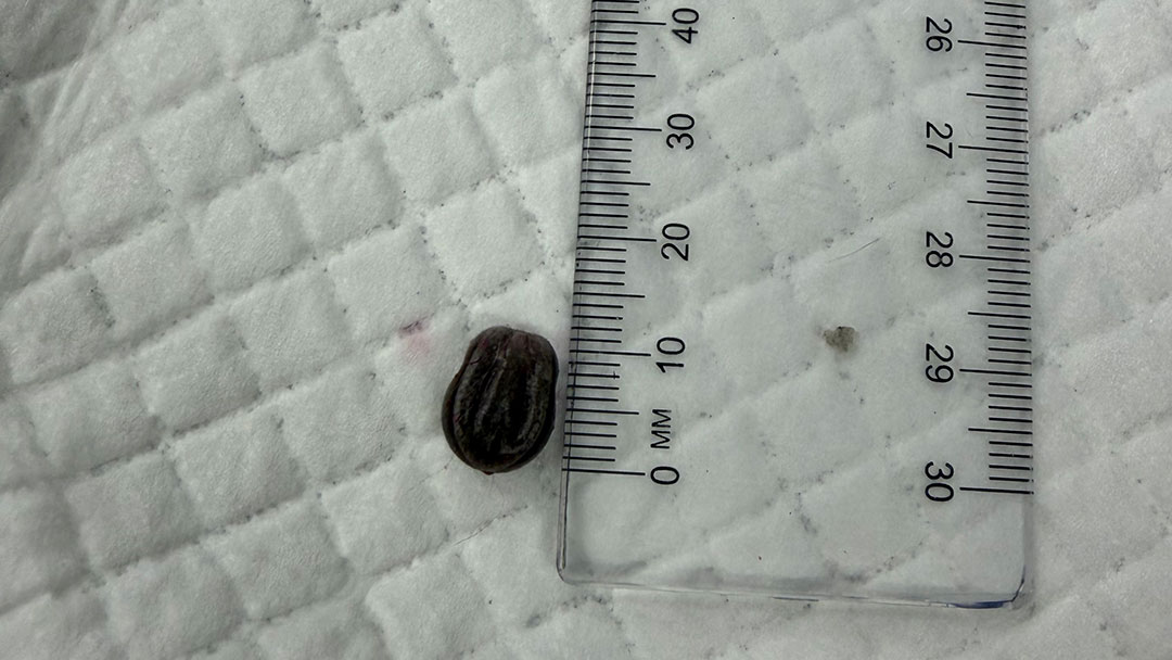 a Tick Next to a Ruler Illustrates the Size of Deadly Parasite Ticks